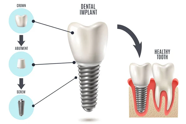 dental-implant-2