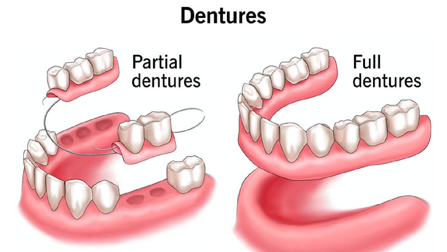 denture-type