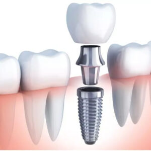 implant