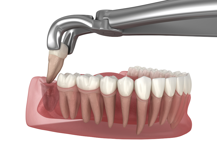 tooth-Extraction-2