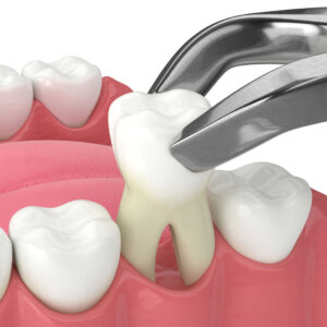 tooth-Extraction