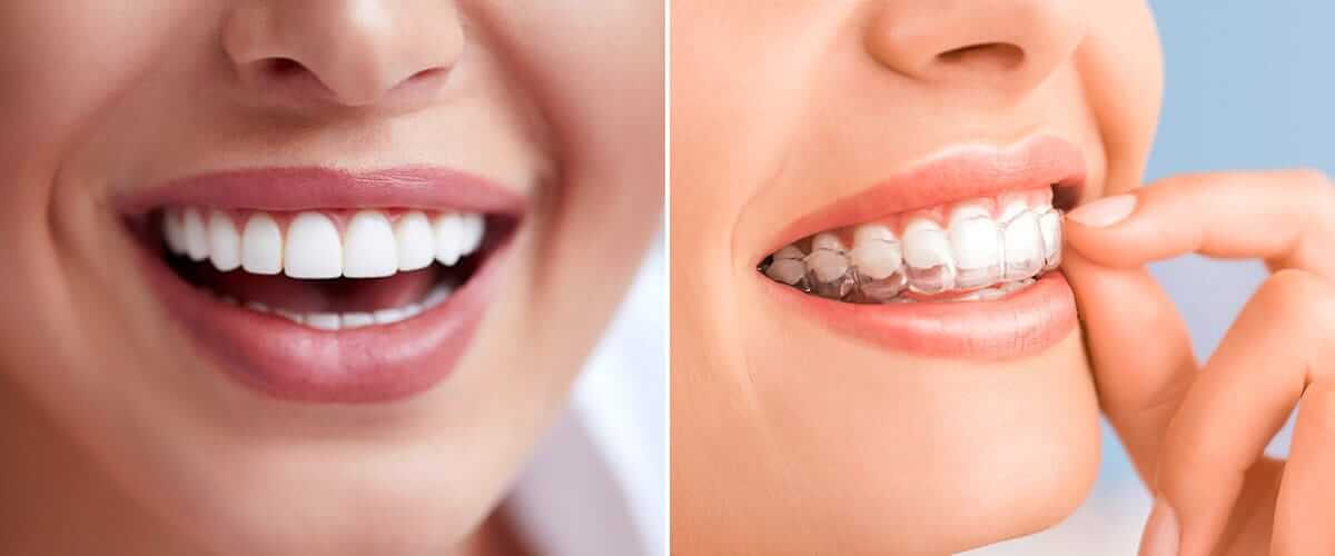 A-Guide-To-Invisalign