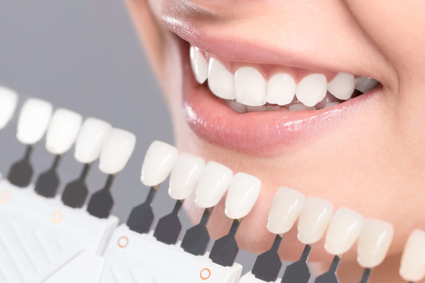 In-Office-Professional-Teeth-Whitening