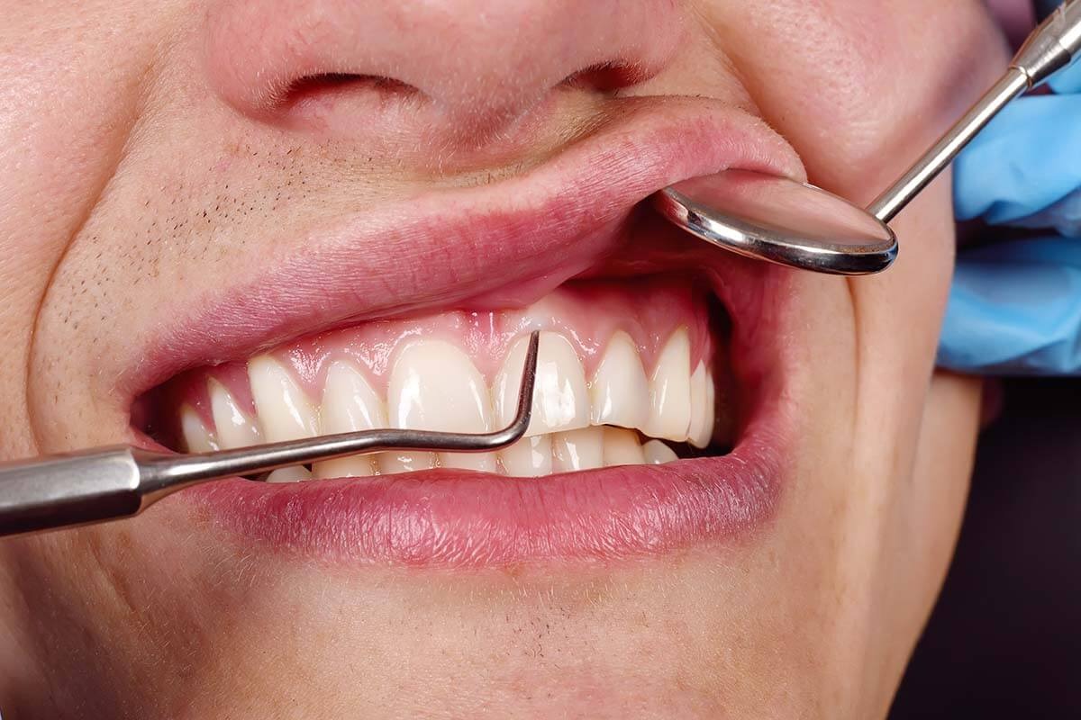 What-are-Common-Periodontal-Trea