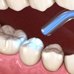 composite-fillings-2107