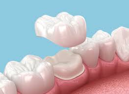 dentalcrown