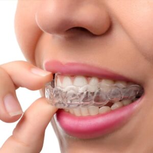 g-invisalign