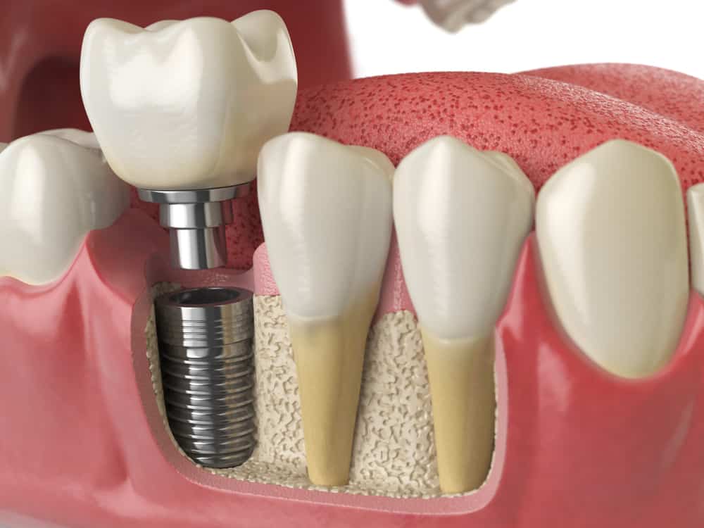 implant-crowns-type