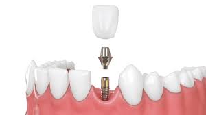 implant