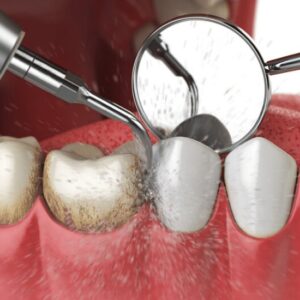periodontal-therapy